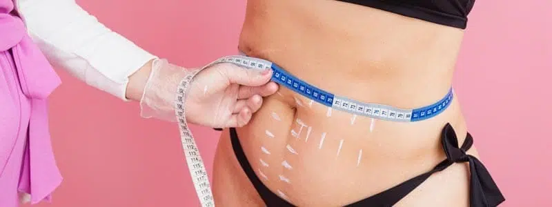 Precio Liposucción en Colombia