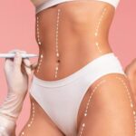 Resultados de una liposucción