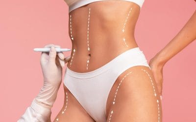 Resultados de una liposucción: ¿Qué esperar a corto y largo plazo?