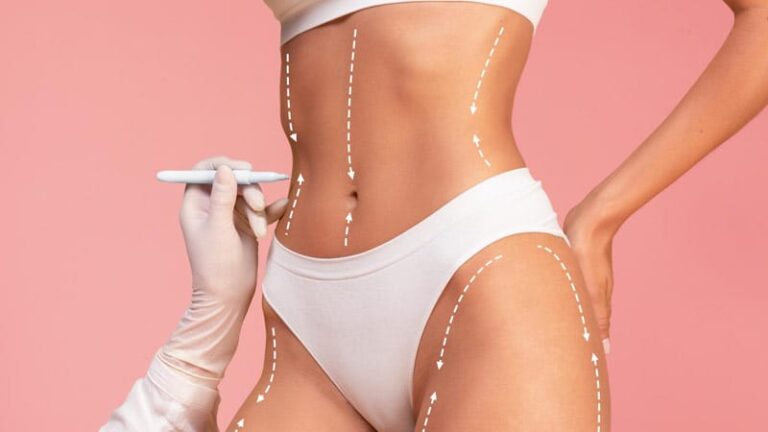 Resultados de una liposucción