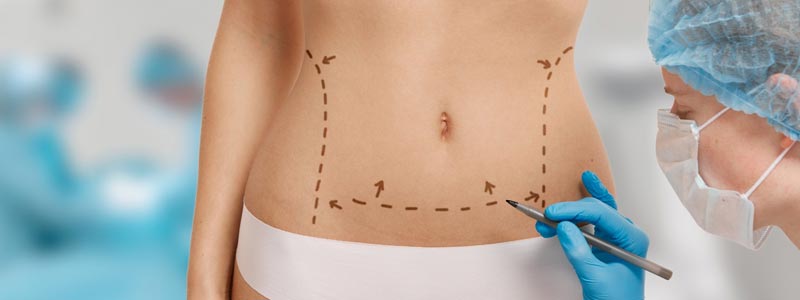 Cuál es el Precio de una Lipoescultura en Colombia