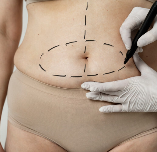 abdominoplastia en bogota
