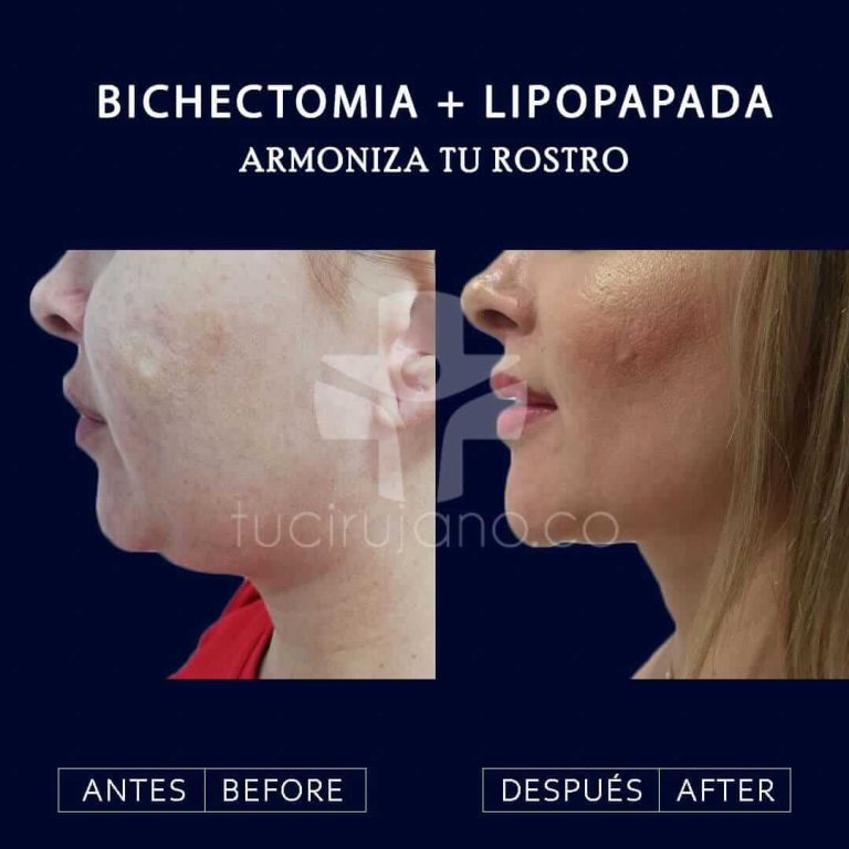 Cirugía de reducción de mejillas en Bogotá