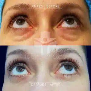 especialistas en blefaroplastia en Bogotá