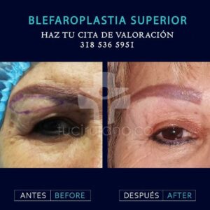 expertos en blefaroplastia en Bogotá