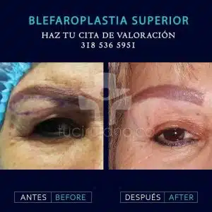 expertos en blefaroplastia en Bogotá