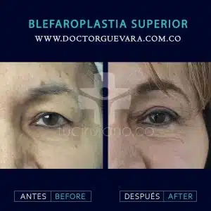 blefaroplastia en Bogotá