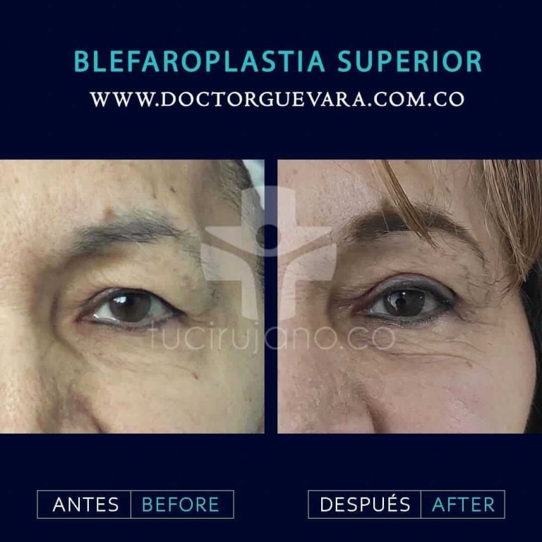 blefaroplastia en Bogotá
