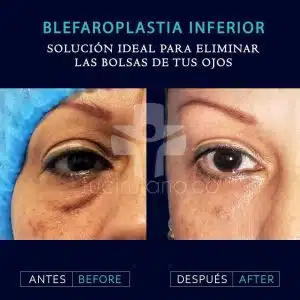 blefaroplastia Bogotá