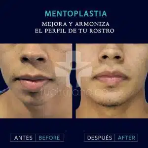 expertos en mentoplastia en Bogotá
