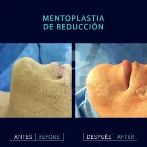 especialistas en mentoplastia en Bogotá