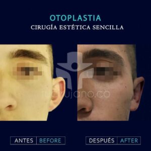 Otoplastia en Bogotá