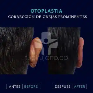 especialistas en Otoplastia en Bogotá