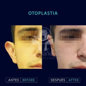 expertos en Otoplastia en Bogotá