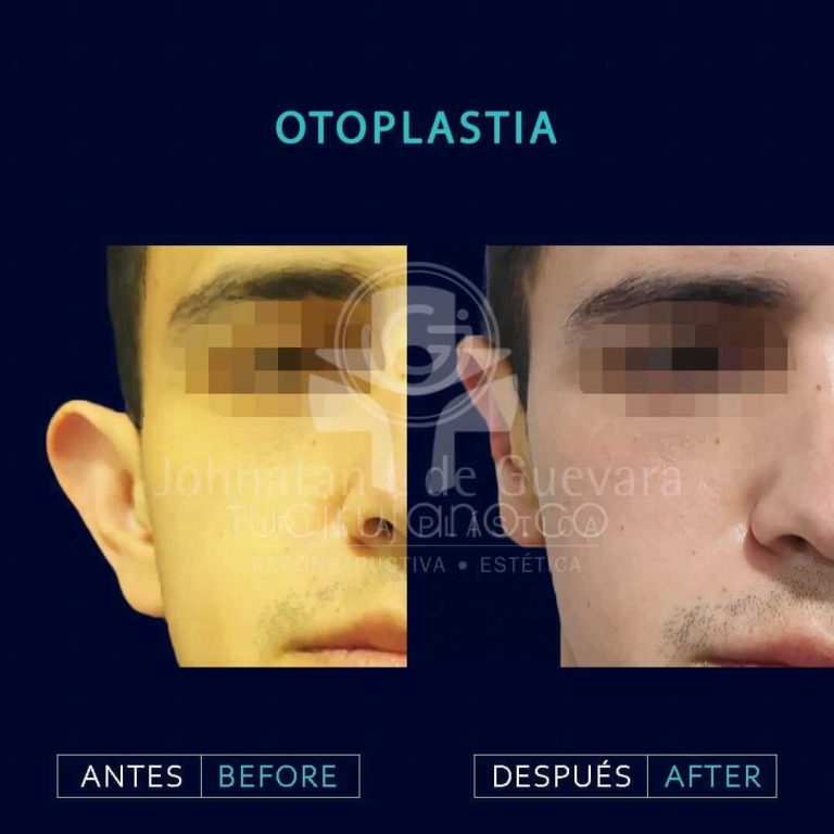 expertos en Otoplastia en Bogotá