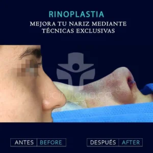 Especialistas en cirugía de nariz en Bogotá