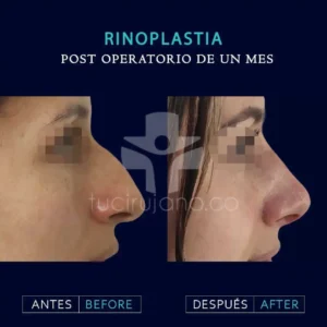 Especialistas en rinoplastia