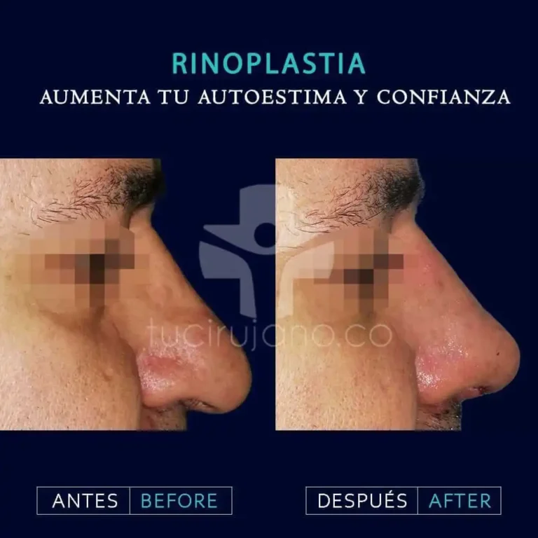 expertos en rinoplastia