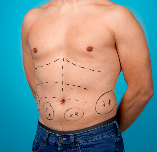 cirujanos especialistas en abdominoplastia en Bogotá