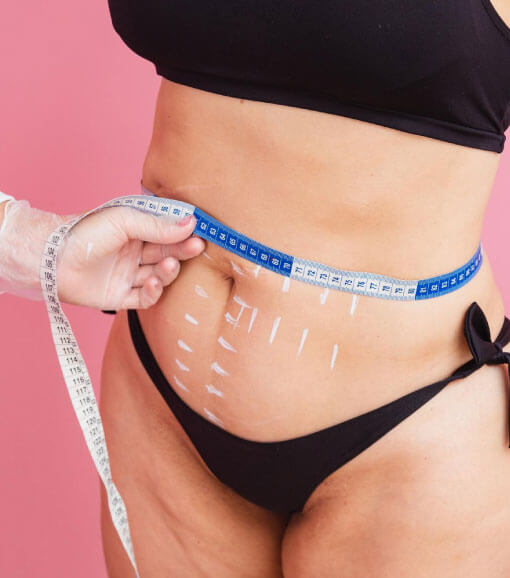 expertos liposuccion Bogota