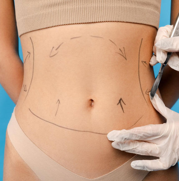 cirugia de Liposuccion en Bogota