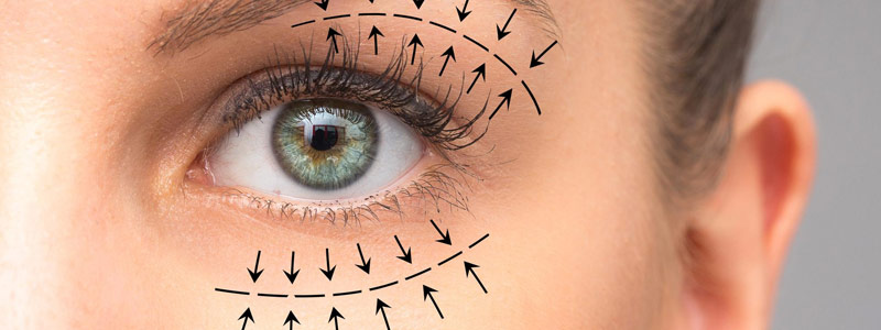precio de una blefaroplastia en colombia