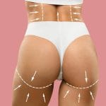 gluteoplastia precio colombia