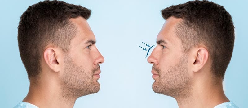 Precio de Rinoplastia Ultrasónica en Colombia