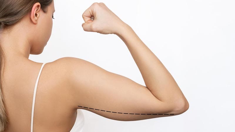 Precio Liposucción de Brazos Colombia