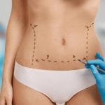 Precio Mini Abdominoplastia en Colombia