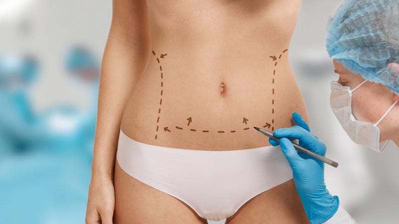 Precio Mini Abdominoplastia en Colombia
