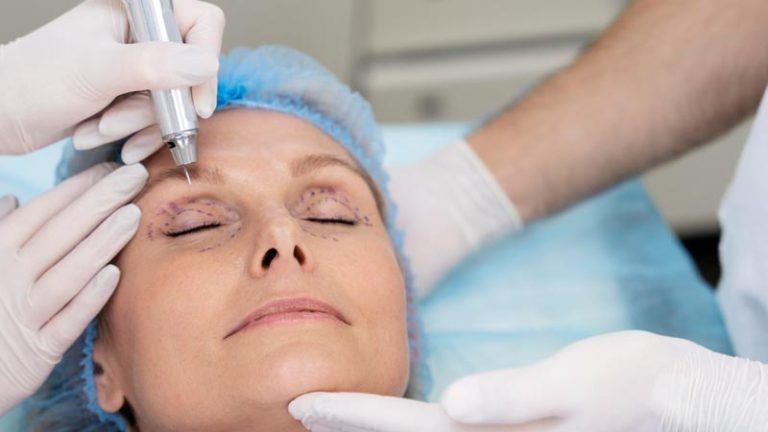 blefaroplastia funcional vs estética