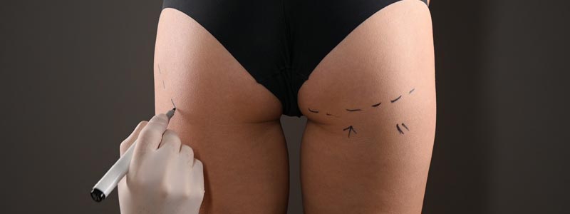 riesgos y complicaciones de la lipotransferencia