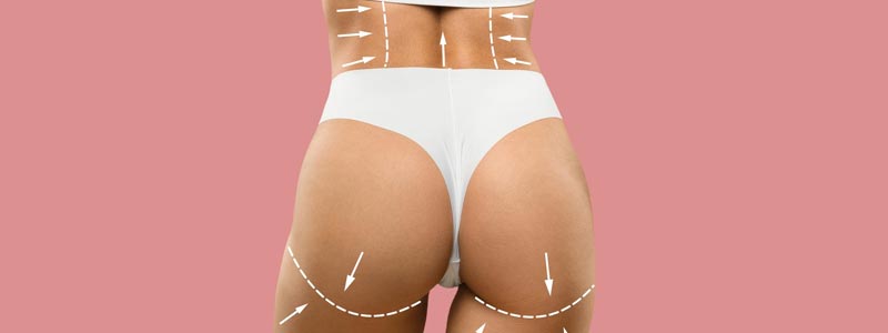 soy candidato lipotransferencia