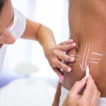 recuperacion lipotransferencia