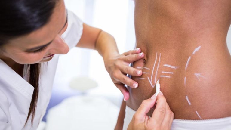 recuperacion lipotransferencia