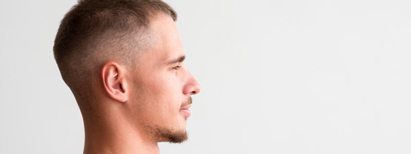 cómo quedan las orejas después de otoplastia