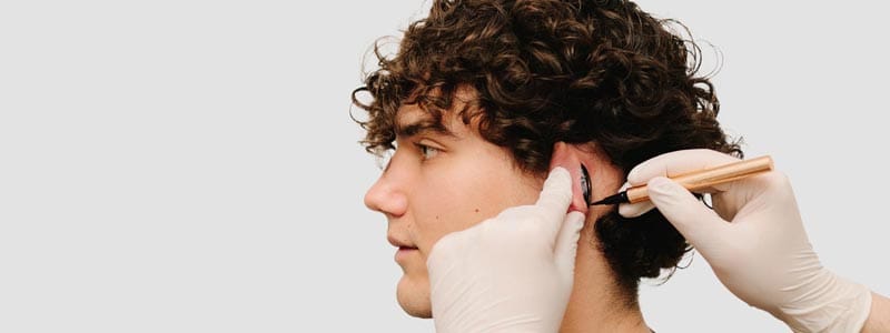 tipos de otoplastia - técnica abierta vs técnica cerrada