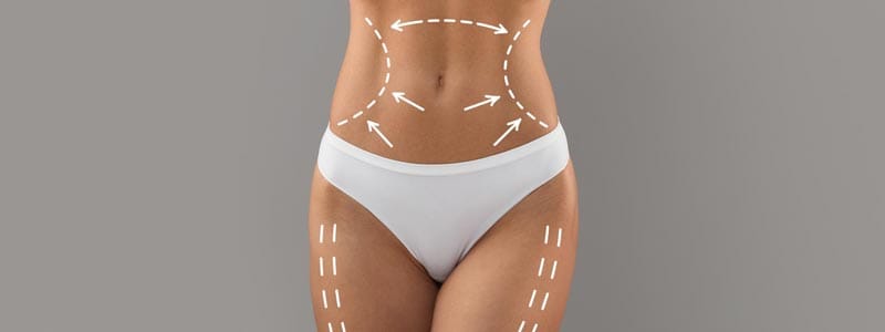 cómo es una liposucción