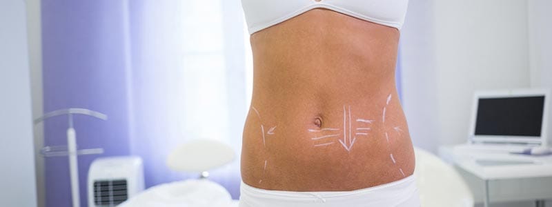 cuáles son los riesgos de una liposucción