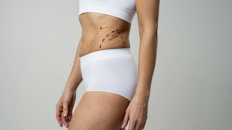qué es la liposucción
