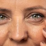 recuperación de la blefaroplastia