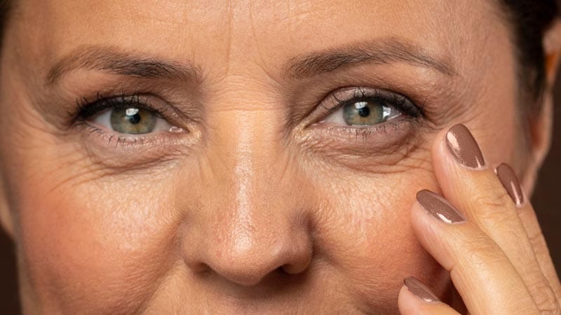 recuperación de la blefaroplastia