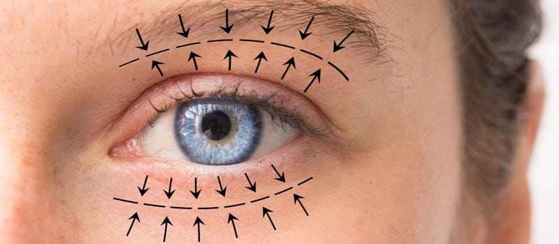 resultados blefaroplastia párpados