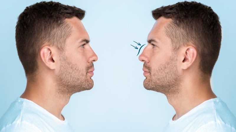 resultados de la rinoplastia