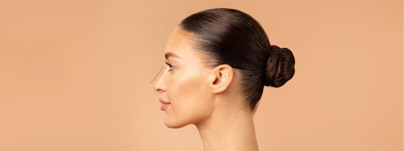 resultados rinoplastia antes después