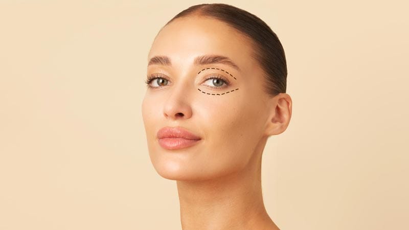 riesgos de la blefaroplastia