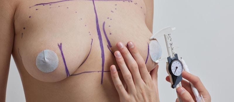 complicaciones mastopexia