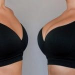 Quién es candidata a una mamoplastia de aumento