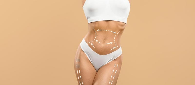complicaciones mommy makeover